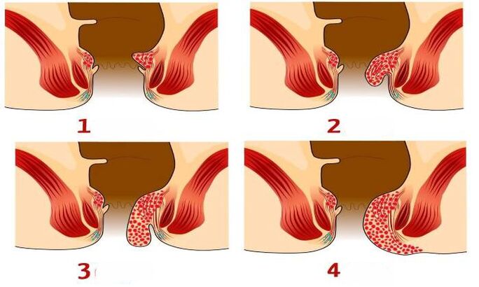 kako izgledajo hemoroidi v različnih fazah