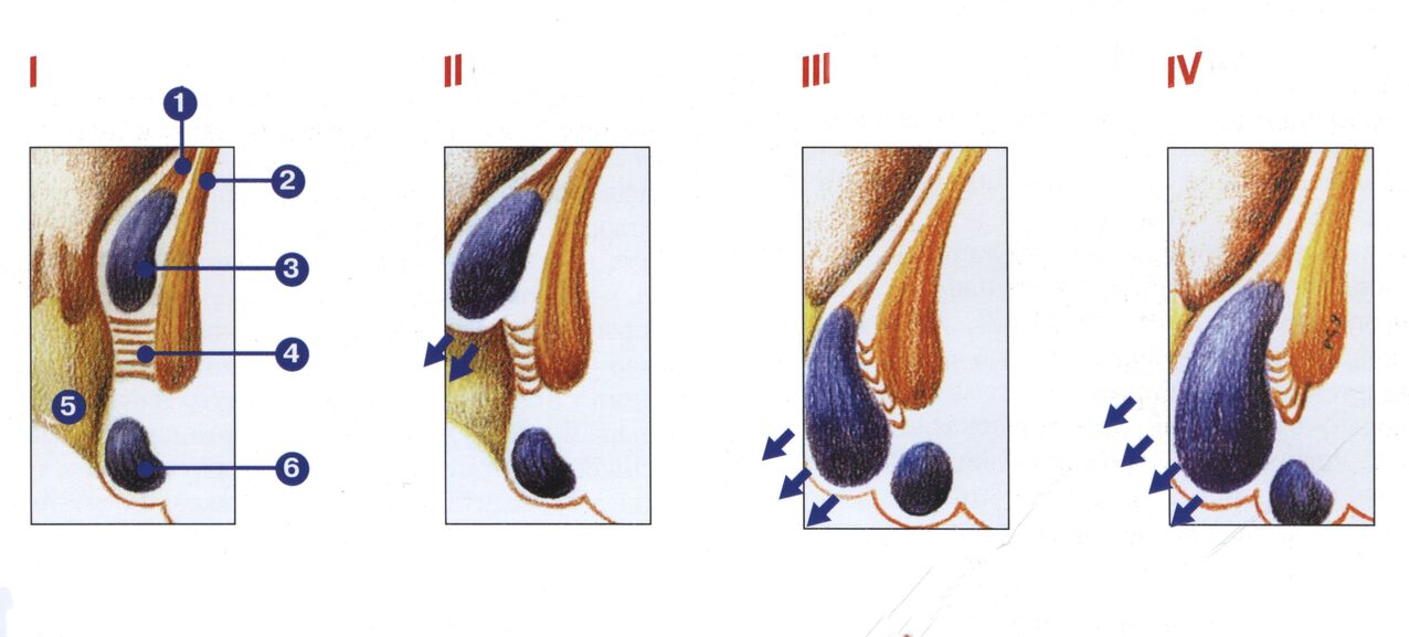 stopnje razvoja hemoroidov